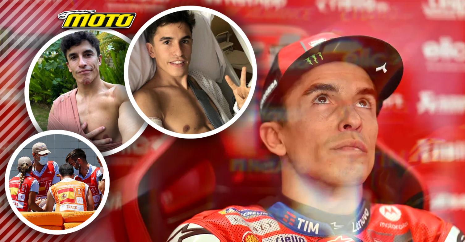 Χειρουργείο για Marc Marquez! Απέτυχε η συντηρητική προσέγγιση – Τοποθέτησαν δύο βίδες