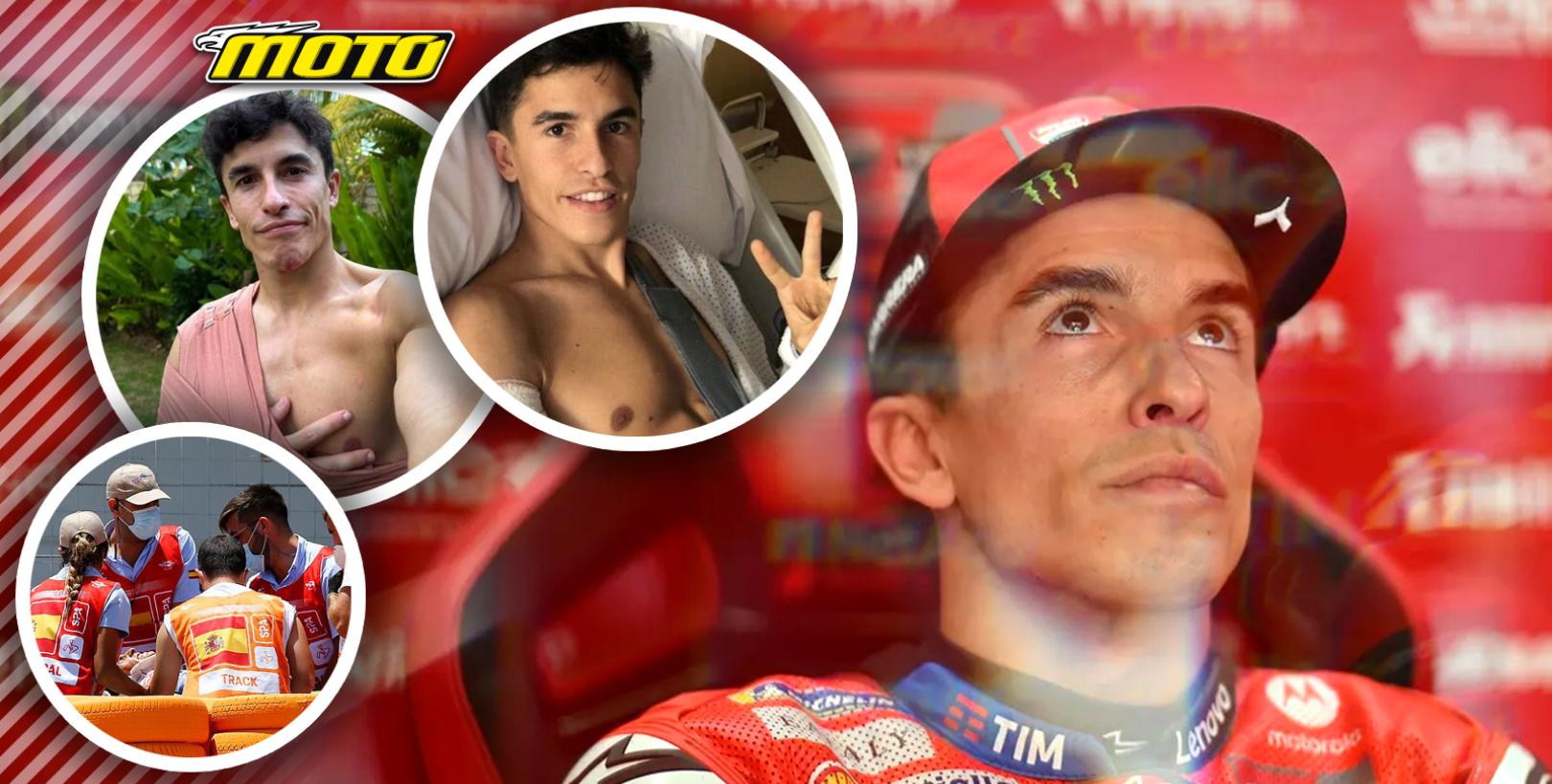 Χειρουργείο για Marc Marquez! Απέτυχε η συντηρητική προσέγγιση – Τοποθέτησαν δύο βίδες